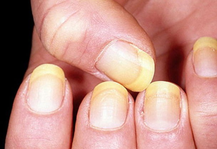 손톱건강관리법 (가로줄, 세로줄, 흑색종, 멍, 백반, 손톱박리증, 울퉁불퉁한 손톱무좀)을 알아보세요