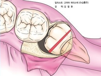  [난발치 사랑니 발치후기] 사랑니발치 리얼후기 / 사랑니발치 식사 / 사랑니발치 통증 / 사랑니발치 붓기 (+회복후기)