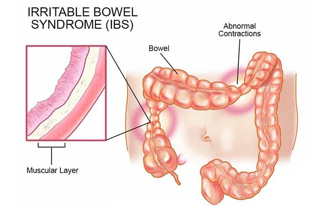  배에서 꾸르륵소리와 과민성대장증후군
