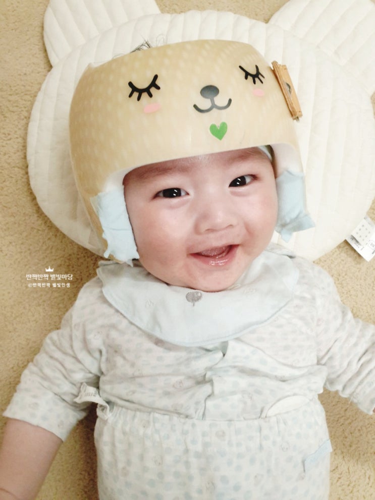  아기 사두증과 단두증 진단 결과 하니헬멧 교정