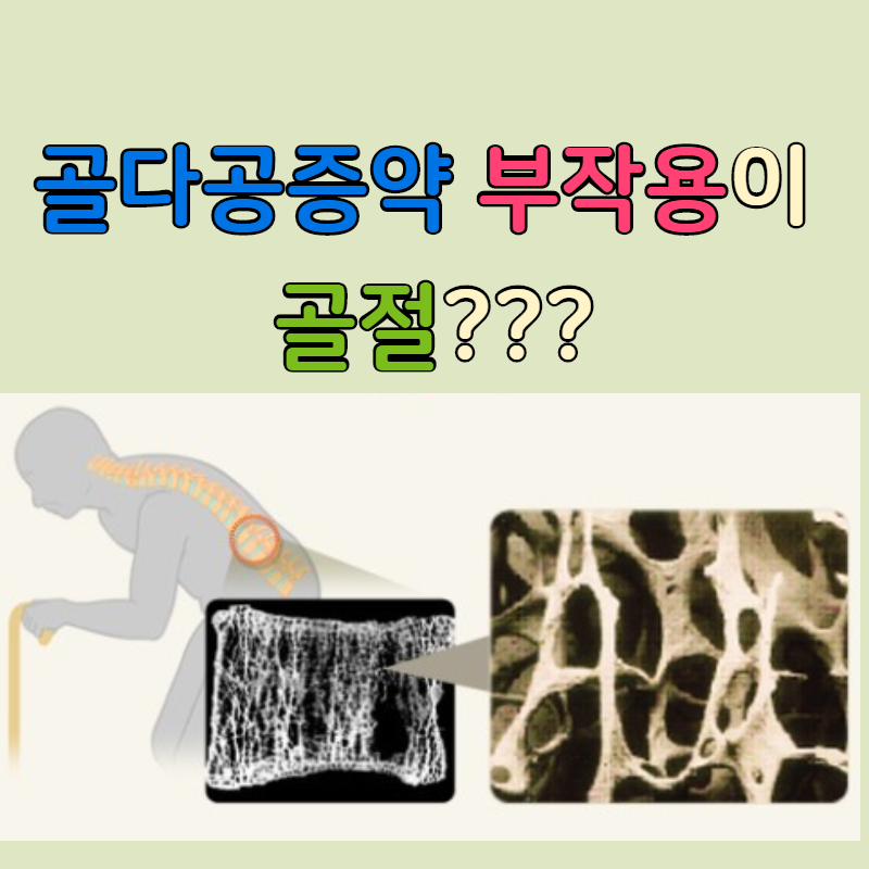 문래역 통증의학과, 골다공증에 더 문래역 통증의학과, 골다공증에 더