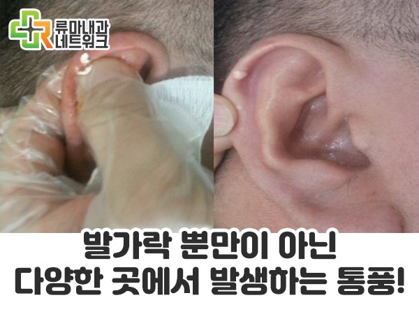 귓바퀴 통증 귀에 혹 부음이나 염증 문제가 이것 때문에?? : 네이버 블로그