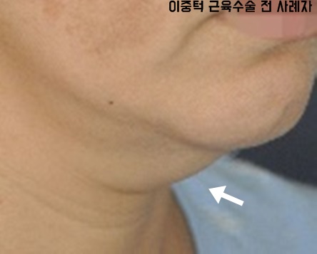  턱살윤곽주사 효과 좋대요?