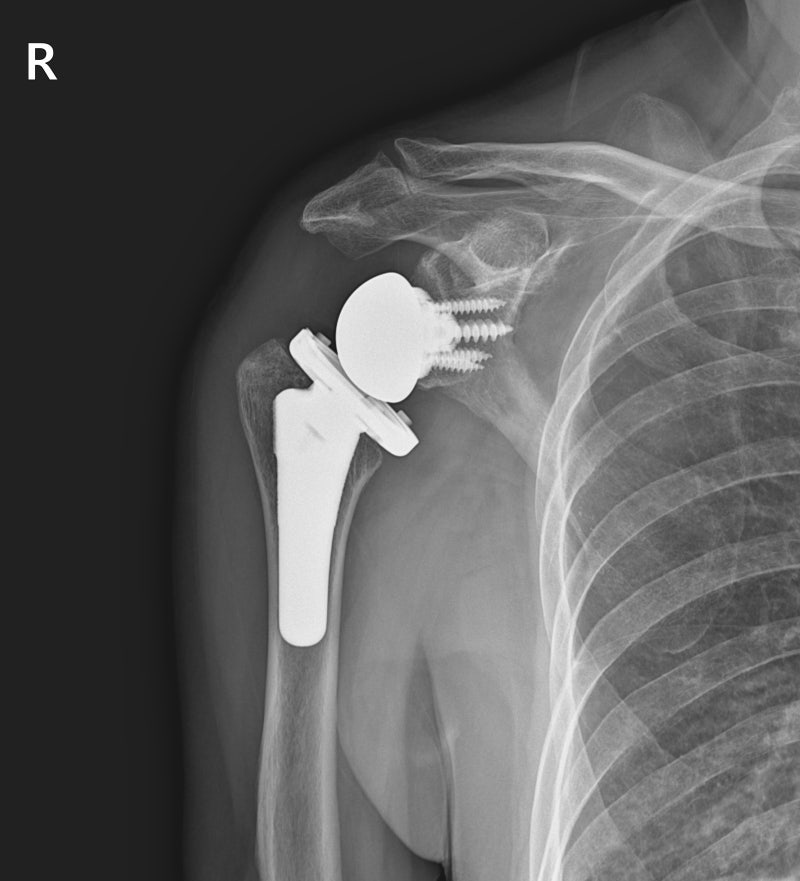 역행성 어깨 관절치환술 (Reverse Total Shoulder Arthroplasty, RTSA) : 네이버 블로그