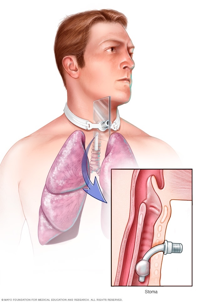 기관절개술(Tracheostomy)