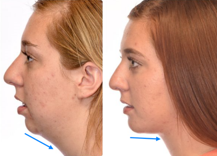 턱끝 전진술(Advancement genioplasty)의 효과에 대하여 성형외과 전문의가 설명해 드립니다. (feat. 이중턱, 턱라인 지방흡입) 턱끝 전진술(Advancement genioplasty)의 효과에 대하여 성형외과 전문의가 설명해 드립니다. (feat. 이중턱, 턱라인 지방흡입)
