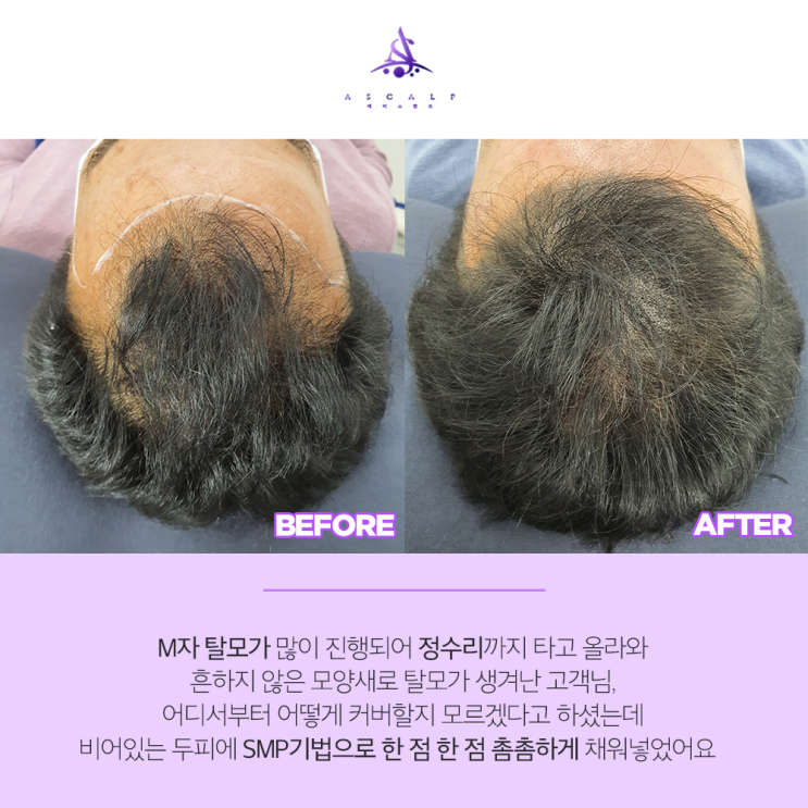  울산엠자탈모 부러움을 한몸에