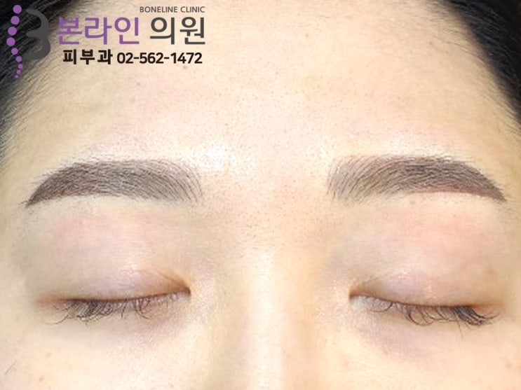  역삼동피부과 눈썹반영구 리터치포함