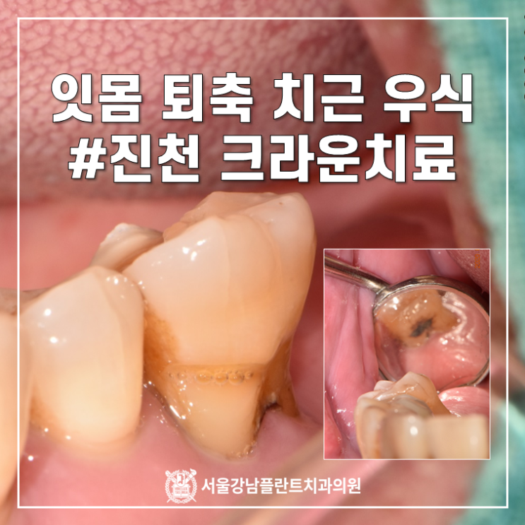 잇몸 퇴축으로 인한 치근 우식 (치아 옆면 충치) - 신경 치료를 동반한 크라운 치료