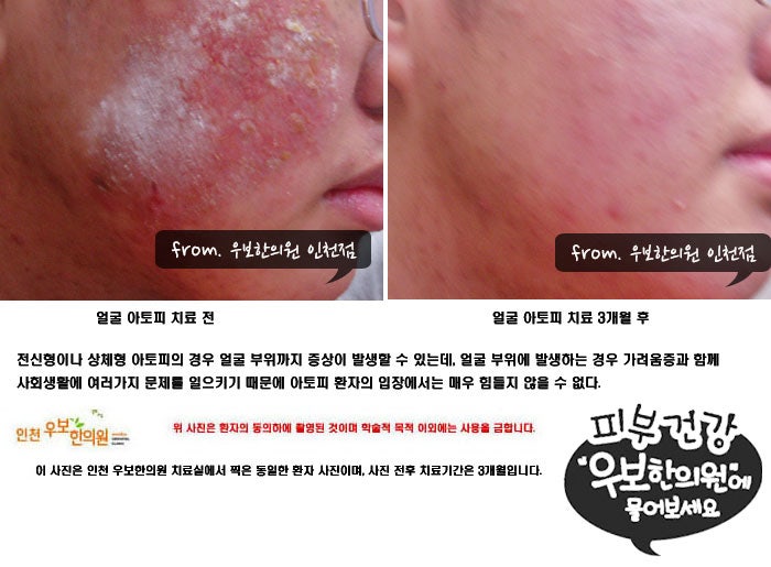 인천습진피부과 진료가 필요하시다면