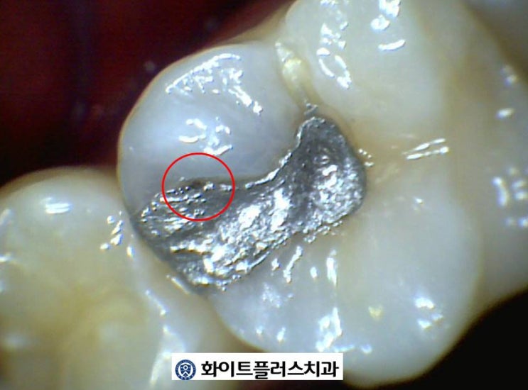  오래된 아말감 교체의 기준은? 신풍역 치과