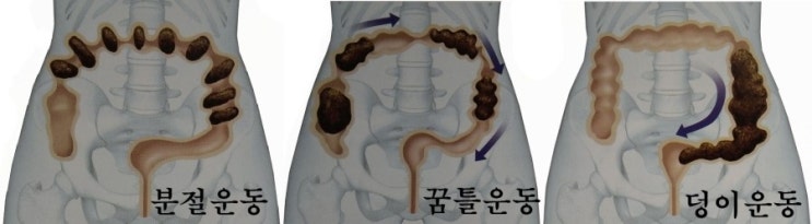 위장 순환에 좌우되는 한국인의 대장암