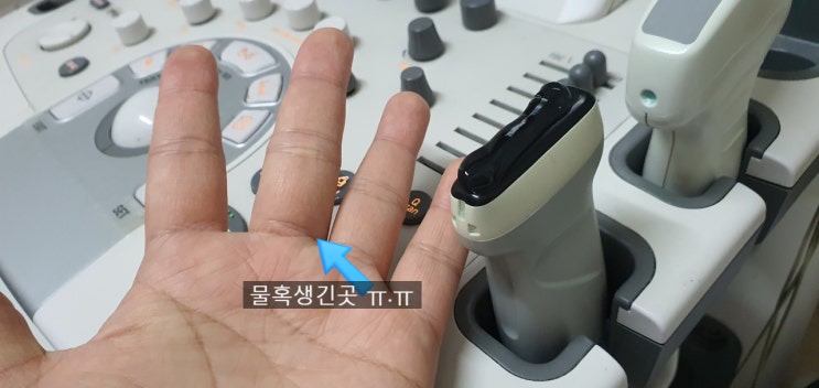  손가락 물혹 통증 방아쇠수지 증상