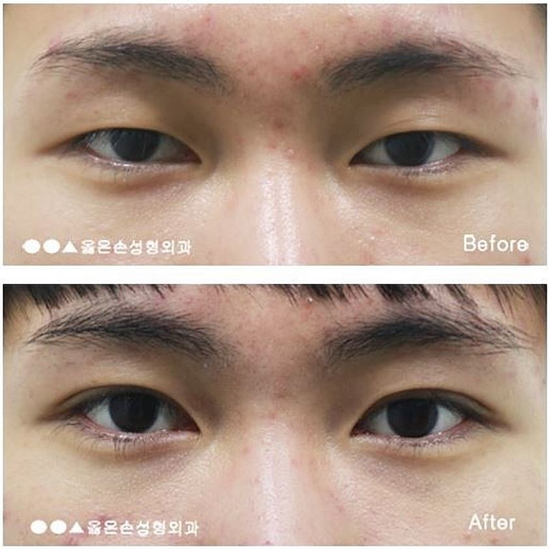  남자속쌍꺼풀수술 자연스러운 변화