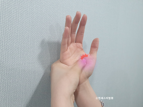 방아쇠수지증후군 (손가락이 구부러진 채 펴지지 않는 증상) / 연세스타병원 방아쇠수지증후군 (손가락이 구부러진 채 펴지지 않는 증상) / 연세스타병원