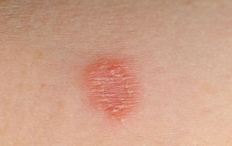 피부곰팡이균의 증상, 종류 및 치료방법 9