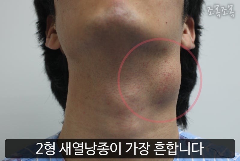 목에 혹이 갑자기 만져지는 중요한 원인 '물혹' - 갑상선 낭종 외에도 다양한 목 물혹 종류 정리 (갑상설관낭종, 새열낭종 등등) : 네이버 블로그 목에 혹이 갑자기 만져지는 중요한 원인 '물혹' - 갑상선 낭종 외에도 다양한 목 물혹 종류 정리 (갑상설관낭종, 새열낭종 등등) : 네이버 블로그