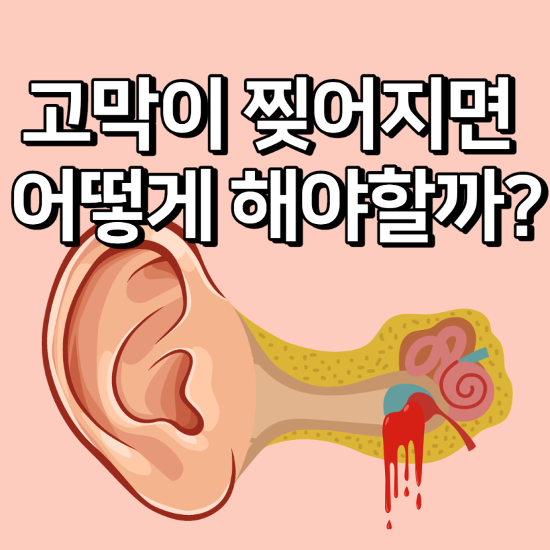 고막 찢어지면 어떻게 될까? 고막천공 증상 및 대처방법