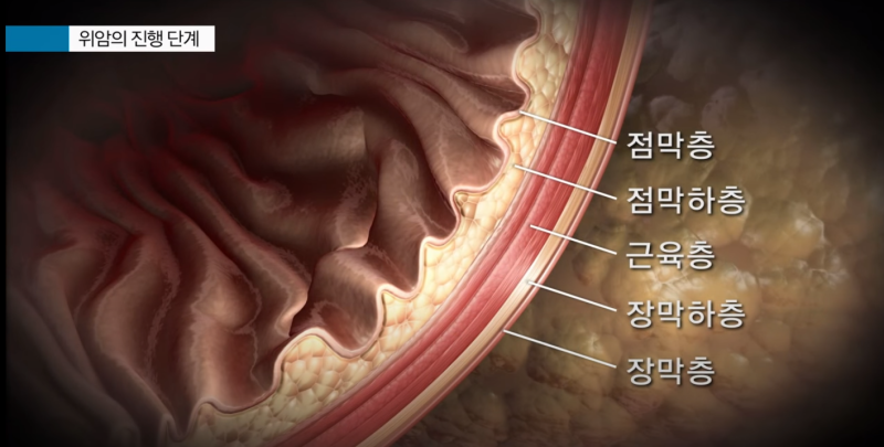 위암 초기증상 '무심코 지나치는 것들!' : 네이버 블로그