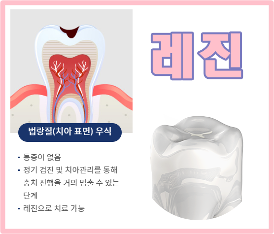 당감동 초기충치치료 레진으로 하루만에 !