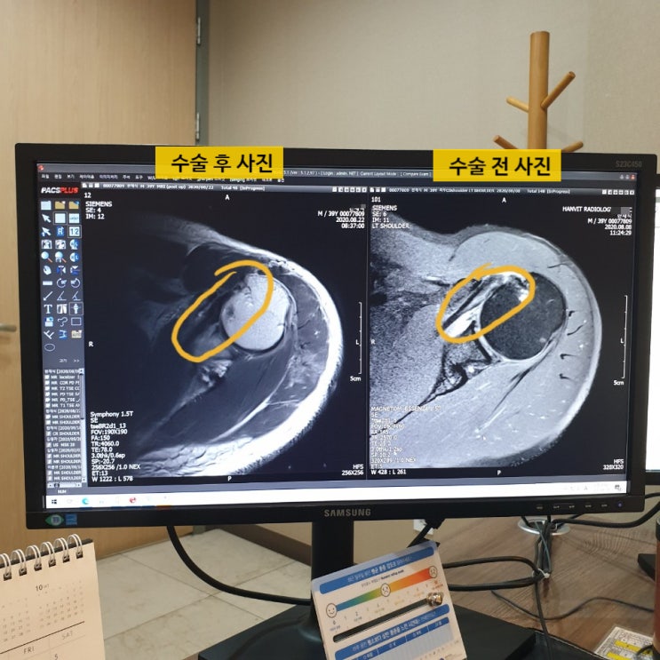  어깨 회전근개 파열 수술 치료기5(어깨보호대 제거 / 초음파검사 / 재활운동 준비)