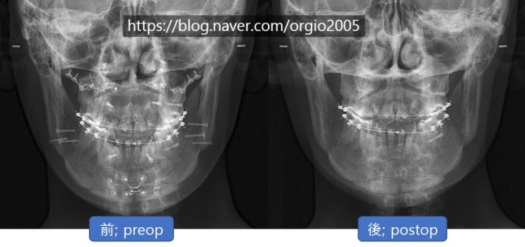  핀제거수술> 양악 수술 후, 고정핀(티타늄핀) 제거