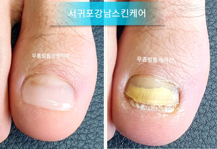  파고드는 발톱, 고민 끝~! 제주도민 최대 55% 할인받고 교정하세요~(서귀포 서귀동)