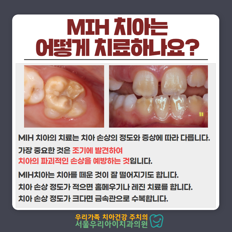 광산구어린이치과 서울우리아이치과 - 우리아이 치아 모양과 색이 이상해요! (MIH, 법랑질 형성부전증) : 네이버 블로그