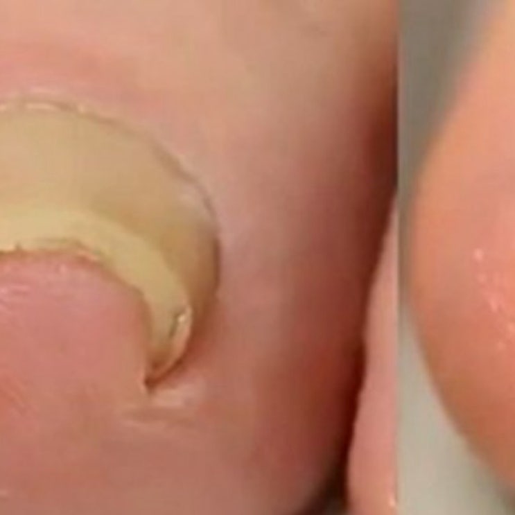 내성발톱자가치료-원인,수술안하기,스스로치료,혼자치료 내성발톱자가치료-원인,수술안하기,스스로치료,혼자치료