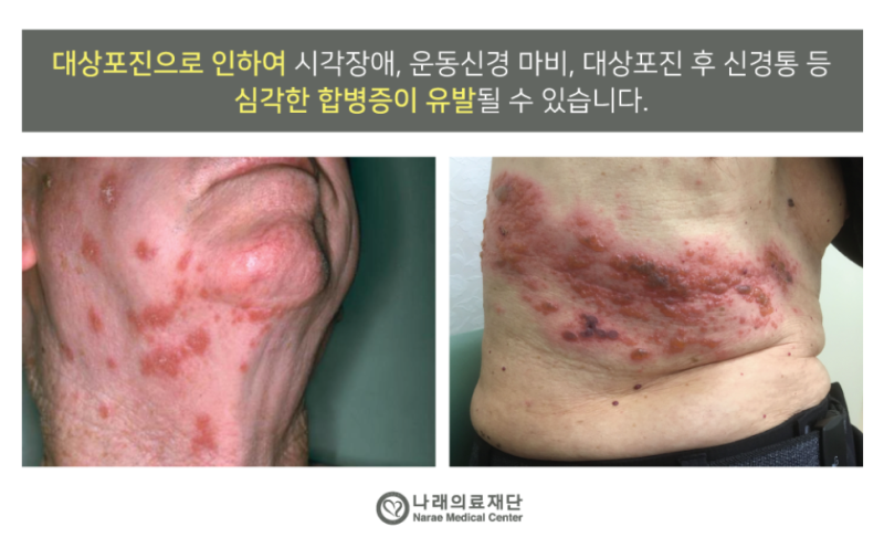 대상포진 예방접종 주사 나이, 주기 4