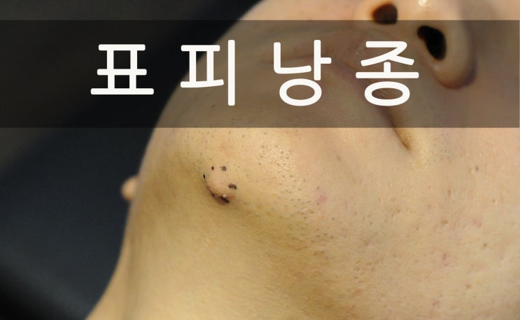  표피낭종 수술 '낭종을 없애는 근본적인 치료'