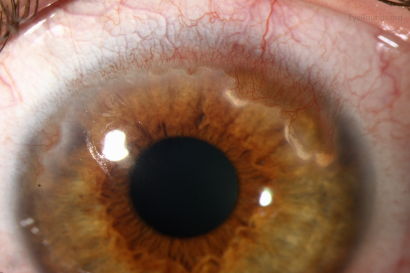 눈 실핏줄 터짐, 결막하출혈 각막 신생혈관 의사가 알려드립니다. : 네이버 블로그