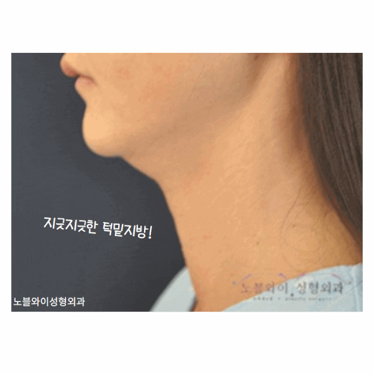  턱밑지방제거 나중에 살안붙는대요