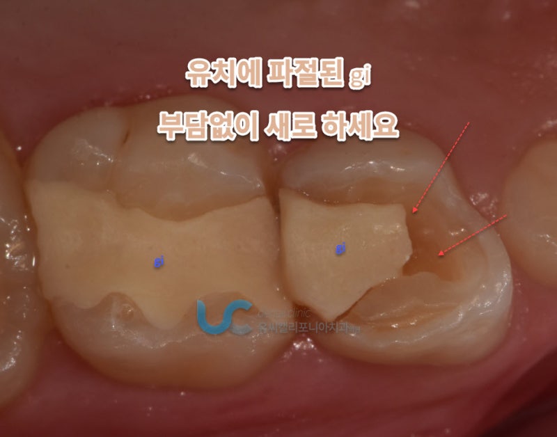 어린이 유치 영구치  충치치료 레진과