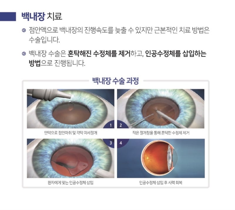 라라렌즈로 편안한 일상생활을~ : 네이버 블로그