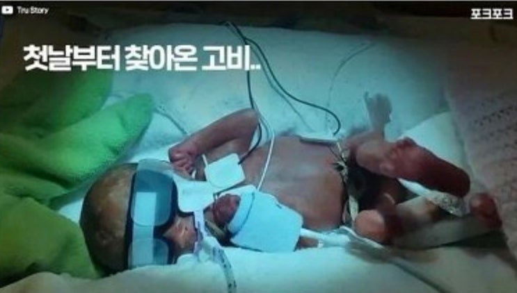  14주 만에 태어난 미숙아의 기적