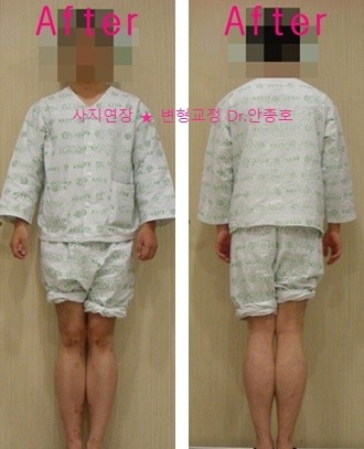  가늘고 날씬한 다리를 위한 키 커지는 수술