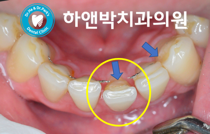 교정 유지 장치가 떨어졌어요 / 교정 종료 후 레진 파절 와이어 탈락 / 교정 철사가 튀어나왔어요 / 치아교정치료 유지관리 / 유지 장치 분실 재제작 재교정 / 인천 인하대 치과 : 네이버 블로그 교정 유지 장치가 떨어졌어요 / 교정 종료 후 레진 파절 와이어 탈락 / 교정 철사가 튀어나왔어요 / 치아교정치료 유지관리 / 유지 장치 분실 재제작 재교정 / 인천 인하대 치과 : 네이버 블로그