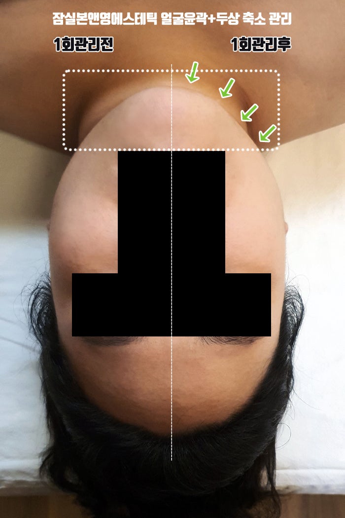 시술,수술없이 옆광대/얼굴폭 머리작아지는법! 얼굴윤곽+두상 1회관리 전후사진후기 : 네이버 블로그 시술,수술없이 옆광대/얼굴폭 머리작아지는법! 얼굴윤곽+두상 1회관리 전후사진후기 : 네이버 블로그