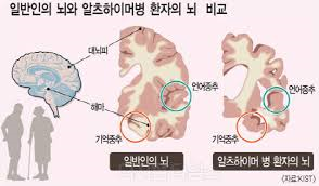 정신간호케이스 치매알츠하이머 원인증상 문헌고찰:치매병태생리 뇌진행단계간호중재