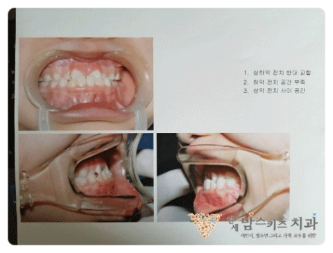 3급 부정교합 환자의 치료와 시기 6