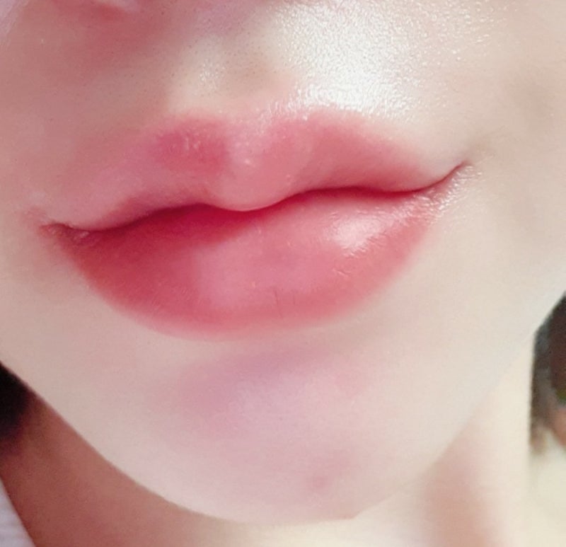피부과 남성 수염 레이저 제모 주기 가격 인중 탈모 턱모낭염없음 3차 3주후기 스플렌더X추천 8