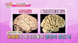 간호학 알츠하이머 치매예방습관 문헌고찰: 알츠하이머환자가족교육 간호진단케이스 간호학 알츠하이머 치매예방습관 문헌고찰: 알츠하이머환자가족교육 간호진단케이스
