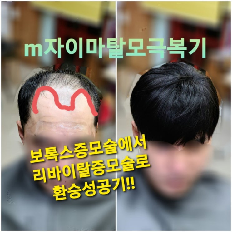 6개월사용 보톡스증모피스의 리폼으로  m자이마탈모 완벽커버하기!! 리바이탈증모술로 환승!!