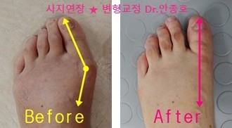  엄지발가락 통증이 없는 무지외반증