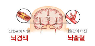 뇌졸증뇌경색징후예방 문헌고찰: 뇌졸증원인종류 위험요소증상 예방영양제 간호케이스 뇌졸증뇌경색징후예방 문헌고찰: 뇌졸증원인종류 위험요소증상 예방영양제 간호케이스
