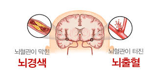 뇌졸증뇌경색징후예방 문헌고찰: 뇌졸증원인종류 위험요소증상 예방영양제 간호케이스