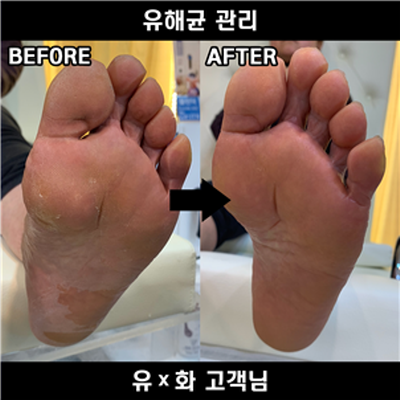 송도 갈라지고 냄새나는 발각질 전문샵 페디아이티엔