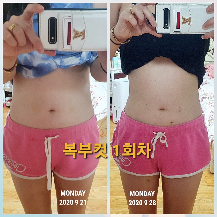  복부지방분해주사후기 컷주사 1회차 (붓기,둘레,멍)