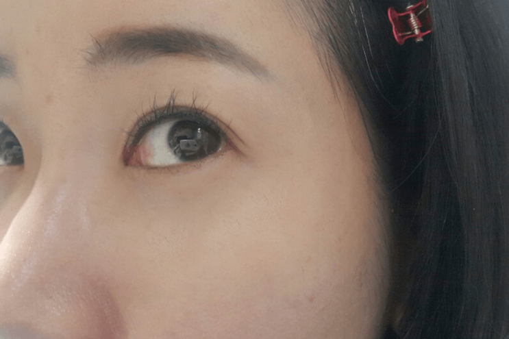  눈밑지방재배치 없이 다크서클없애는법